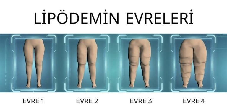 Uzmanından lipödem uyarısı