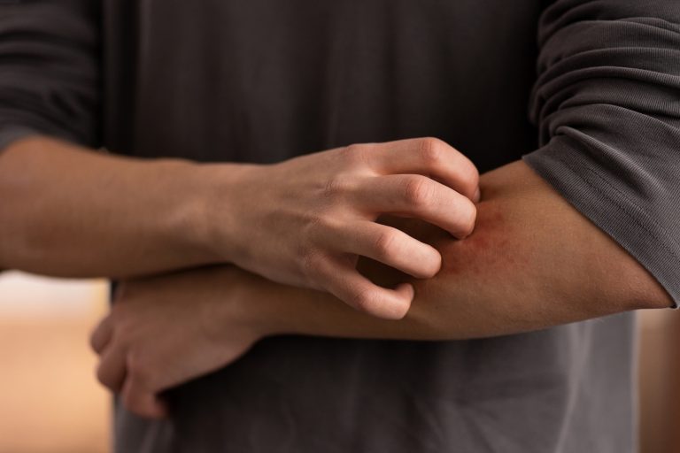 Alerji mi, histamin dengesizliği mi? Benzer belirtiler yanıltıcı olabilir